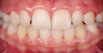 Patient with crowded teeth, after treatment