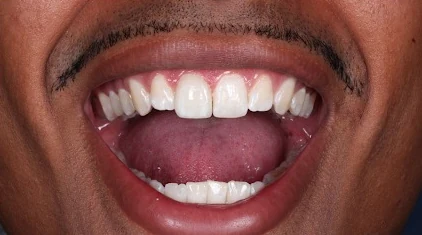 Patient with gap between front teeth, after treatment
