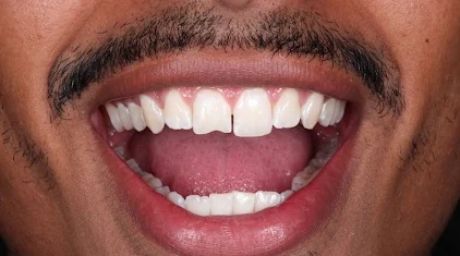 Patient with gap between front teeth, before treatment