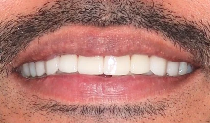 Patient with smile makeover, after treatment