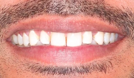 Patient with smile makeover, before treatment
